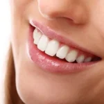 pembe estetik gummy smile tedavisi