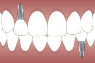 implant tedavisi temsili implant fiyatları 2022